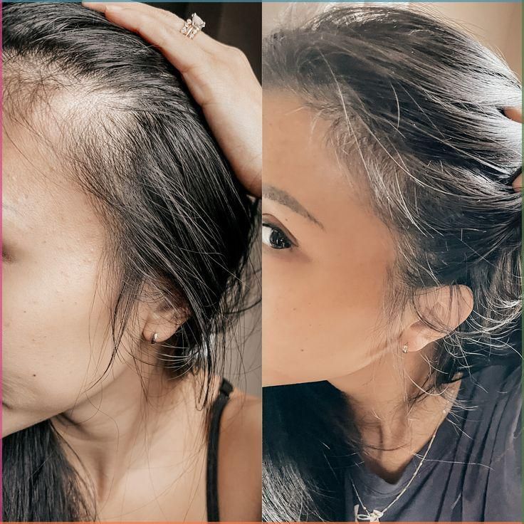MAXORA VITAFOAM ™ Hair Growth Formula