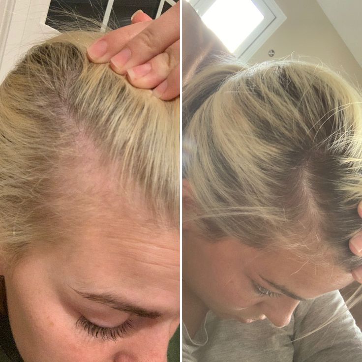 MAXORA VITAFOAM ™ Hair Growth Formula